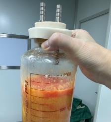 嵊州水动力吸脂手术要做多久？